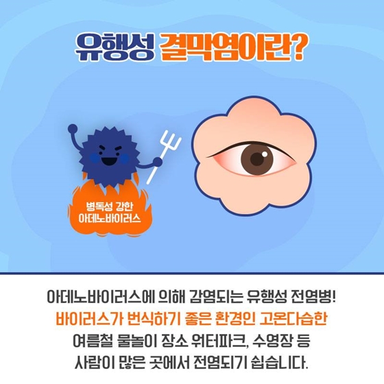 여름철 물놀이 후 골칫거리, 유행성 결막염