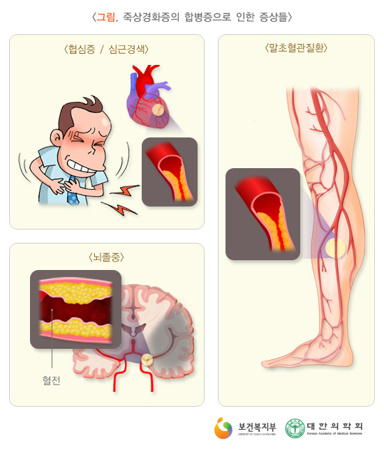 죽상경화증