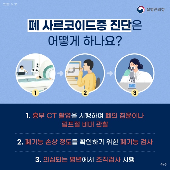 담배도 피우지 않는데 마른 기침이 발생한다면 혹시.. ‘폐 사르코이드증’?