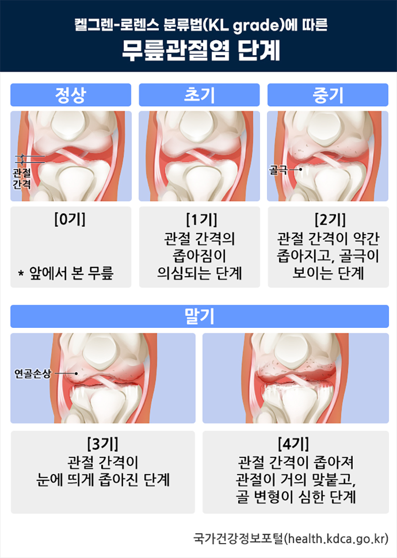 켈그렌-로렌스 분류법에 따른 무릎관절염 단계