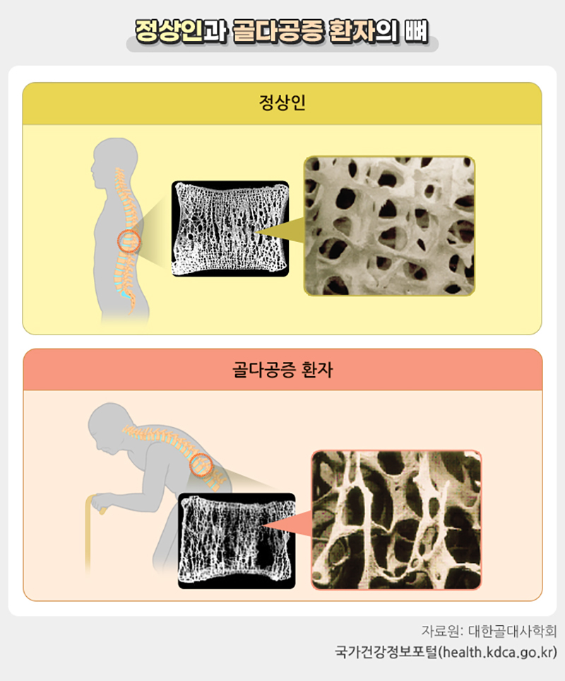 정상인과 골다골증 환자의 뼈